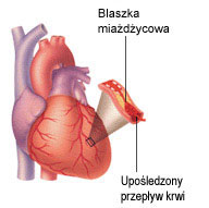 choroba-wiencowa-przyczyny-2005